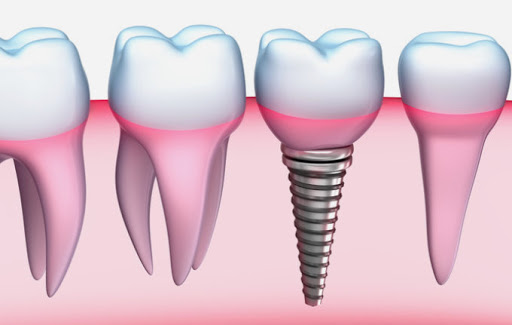 Bone Graft