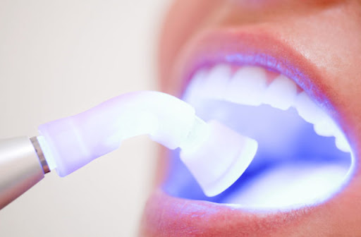 Teeth Whitening