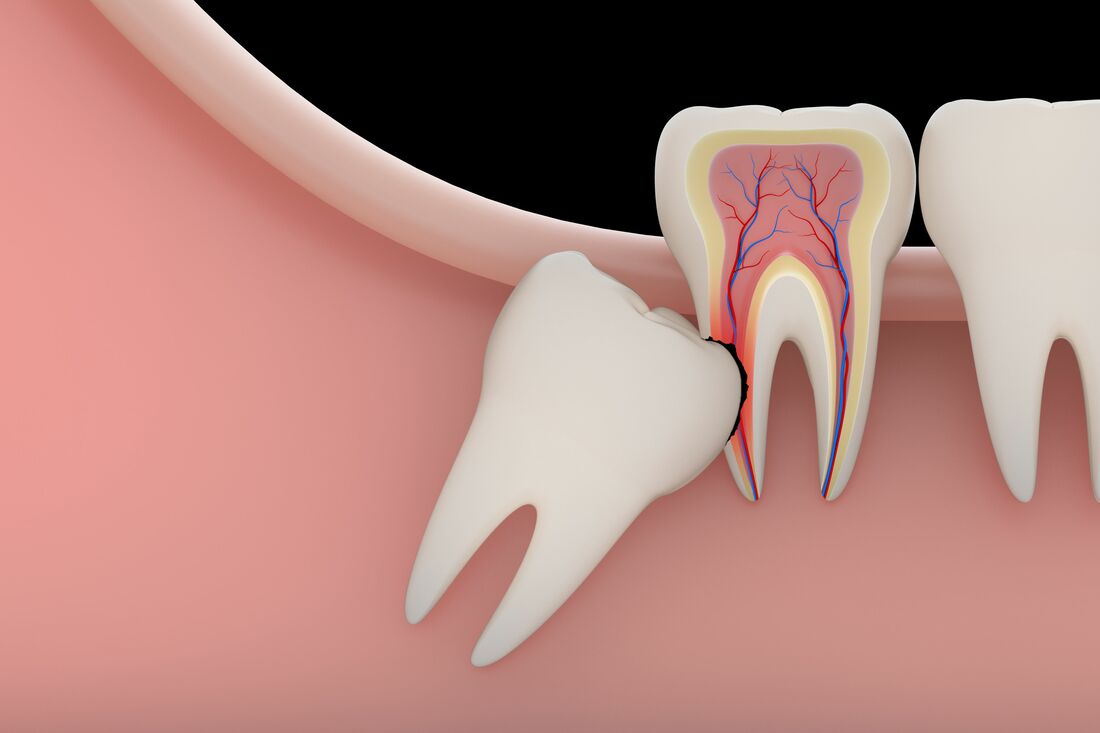 Tooth Extractions